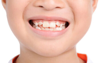Những nguyên nhân phổ biến khiến răng mọc lệch ở trẻ