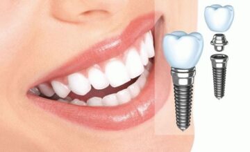 Bí quyết giúp trồng răng Implant không đau