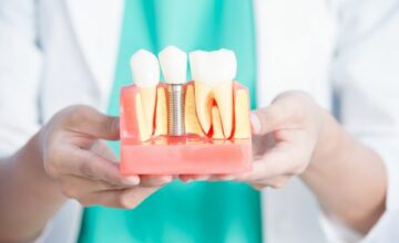 Vì sao nên xem trồng răng Implant là một nguồn đầu tư?