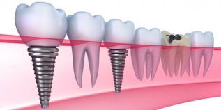 Thời Điểm Tốt Nhất Để Cấy Implant Sau Nhổ Răng?