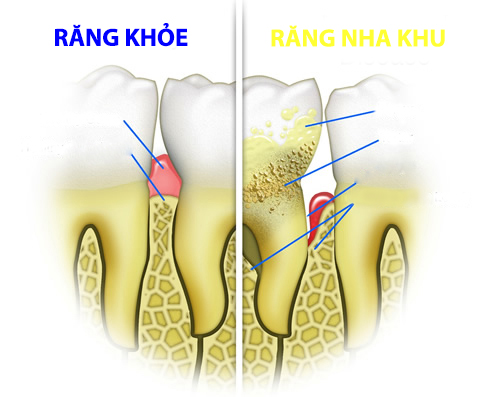 Bệnh nha chu - không đơn thuần là sức khỏe răng miệng