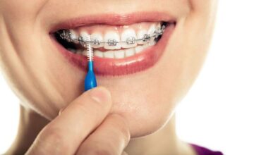 Vì sao cần điều trị viêm nha chu và sâu răng trước khi niềng răng?
